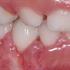 کیست دندانی چیست و راه‌های پیشگیری از آن کدامست؟
